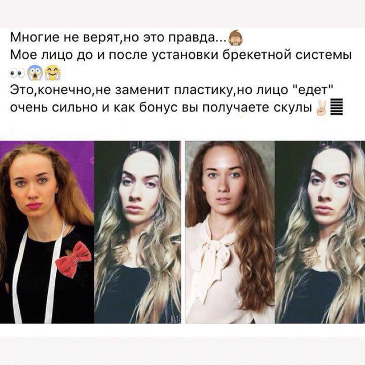 Мне 30 лет...и я в брекетах